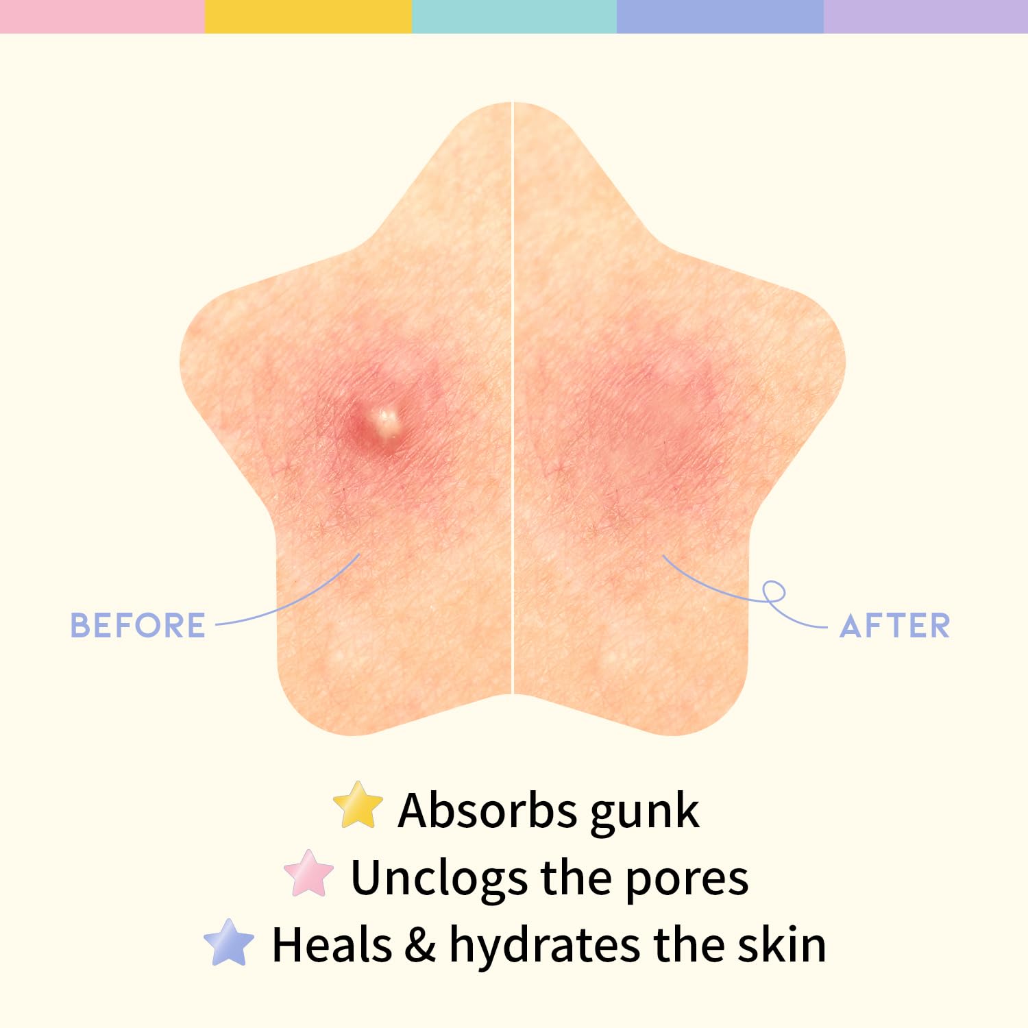 [ OOTD ] Star Spot Acne/Pimple Patch for Face 12mm X 80Pcs (16pcs x 5ea)